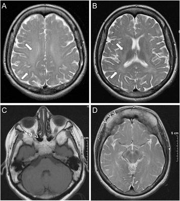 Novel GJA1/Cx43 Variant Associated With Oculo-Dento-Digital Dysplasia Syndrome: Clinical Phenotype and Cellular Mechanisms